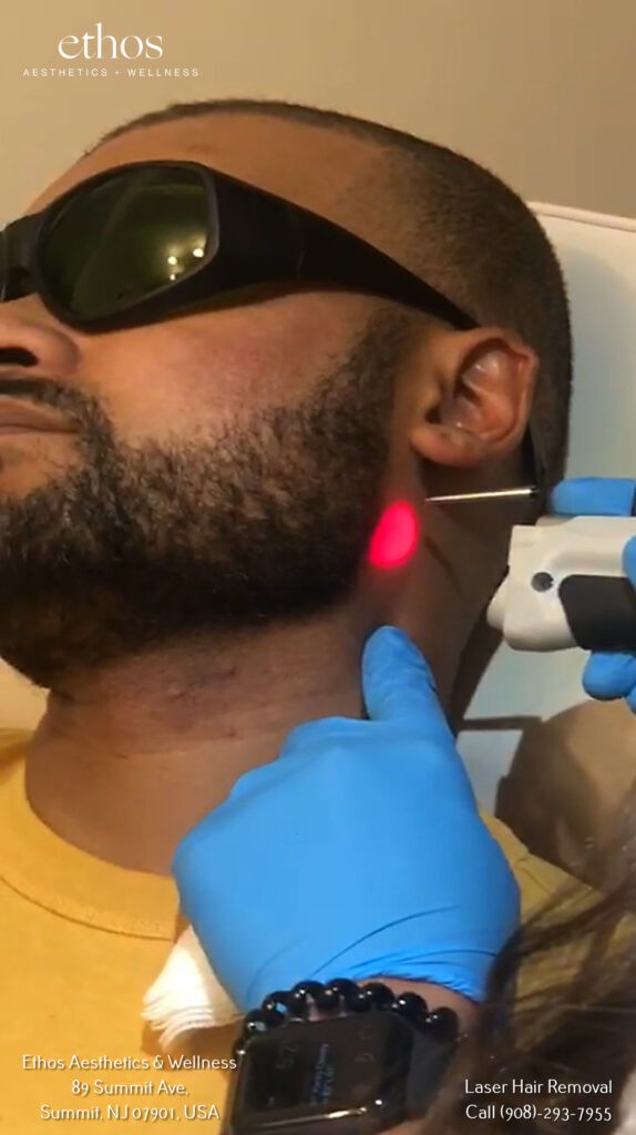 a man getting facial laser hair removal treatment