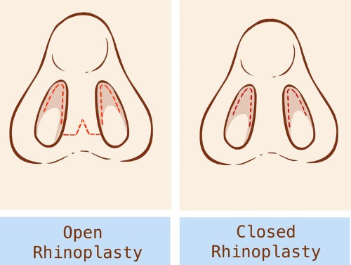 closed and open rhinoplasty